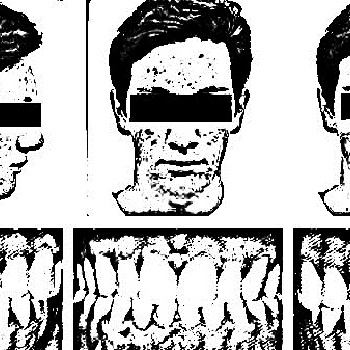 Overbite - demo - Tape (2013)