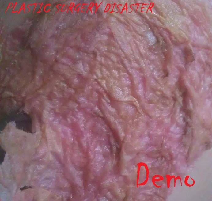 Plastic Surgery Disaster - demo - CD (2014)